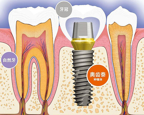 韩国奥齿泰种植体