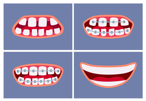 金属托槽牙齿矫正流程图