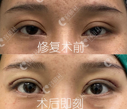 杭州格莱美双眼皮手术案例展示