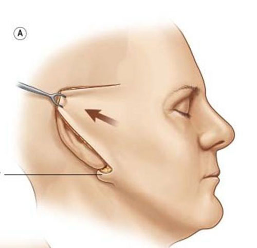 面部拉皮手术示意图