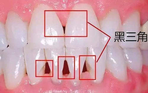 牙龈萎缩导致牙缝大