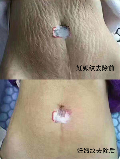 肚子上有妊娠纹怎么办郑州一家医院去妊娠纹对比图公开