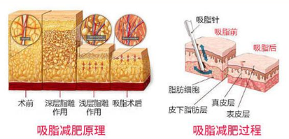 吸脂原理