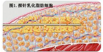 威塑吸脂