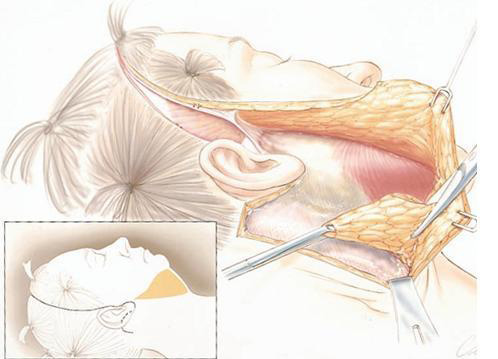 拉皮手术上皮组织与SMAS筋膜层剥离