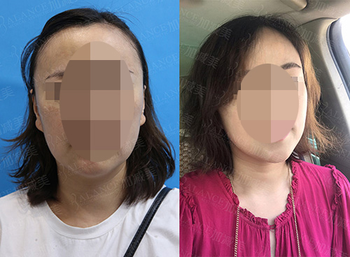 北京加减美医疗美容医院面部提升对比照片