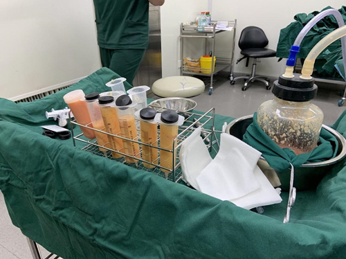 吸脂手术要到正规医院 吸脂手术要到正规医院