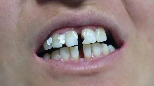 牙齿龋坏和牙周病导致门牙缝隙变大