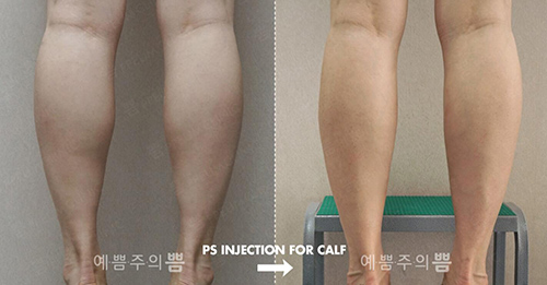 韩国明洞丽芬聚PPEUM医院瘦小腿案例前后对比