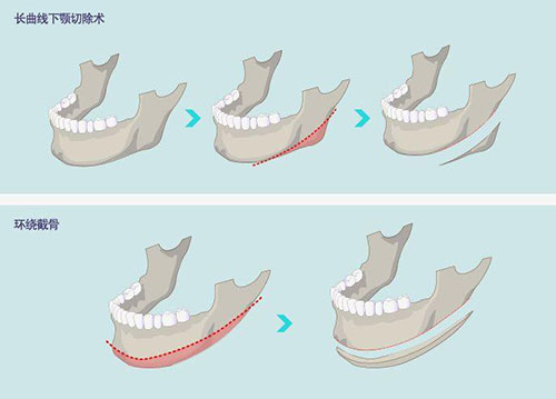 下颌角整形手术示意图