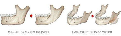 下颌角整形手术示意图