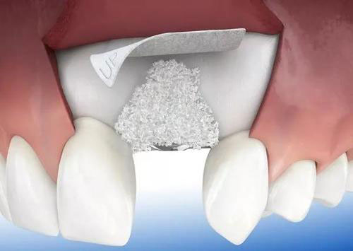 种植牙植骨粉示意图