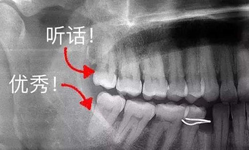 智齿没长出来能拔吗?南京江宁区拔智齿哪个医院好?