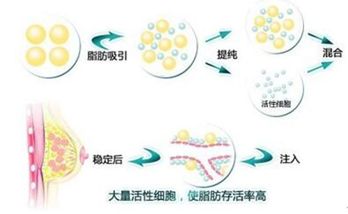 隆胸是假体好还是自身脂肪好?对比材料效果来看区别在哪?