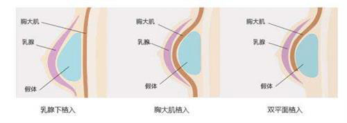 隆胸是假体好还是自身脂肪好?对比材料效果来看区别在哪?