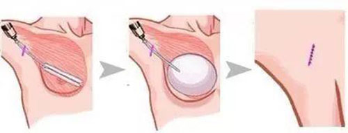 隆胸植入的过程示意图