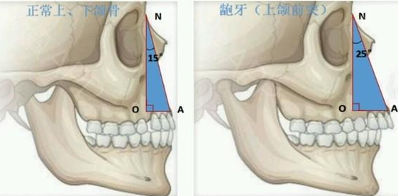 龅牙骨骼图