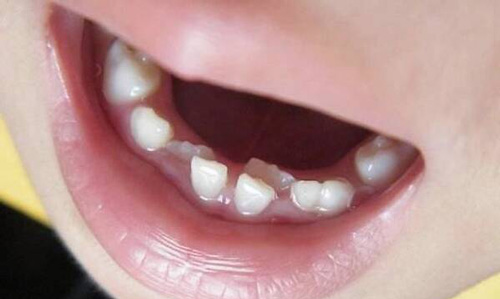 孩子牙齿长歪是什么原因造成的?父母做好这几点便能改善