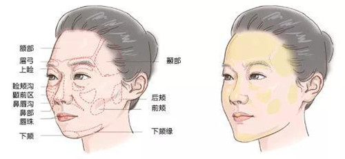 面部脂肪填充好处和坏处示意图