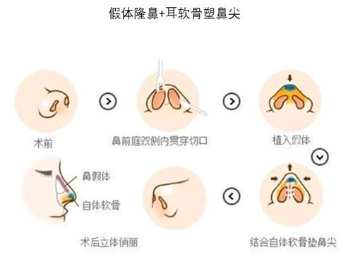 耳软骨隆鼻会吸收吗？做三年吸收掉了是为什么？