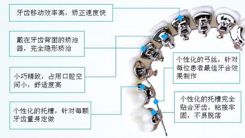 分享北京舌侧矫正价格，告诉你为什么舌侧矫正那么贵！