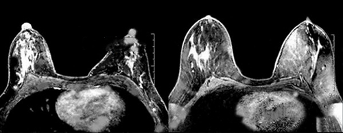 自体脂肪隆胸前后CT拍照对比