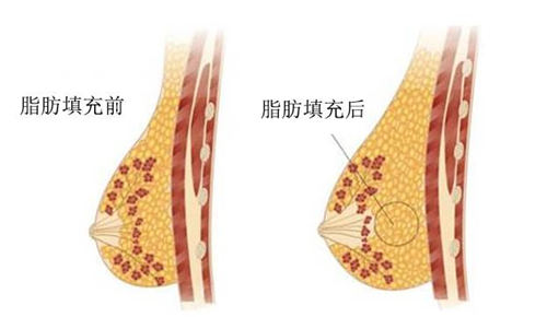 脂肪填充胸部前后对比