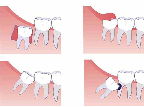 智齿生长示意图
