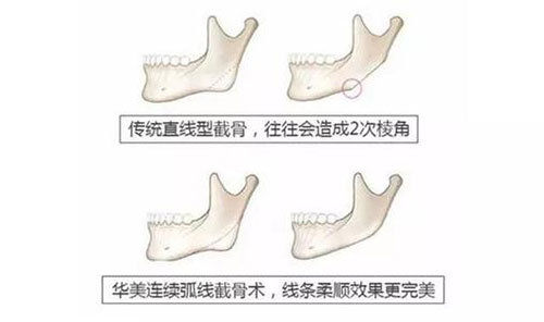 下颌角整形到底该不该留角?下颌角留角好看还是不留好看!