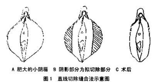 阴唇缩小术示意图