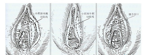 阴唇缩小术示意图