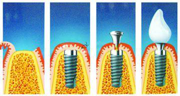 种植牙过程