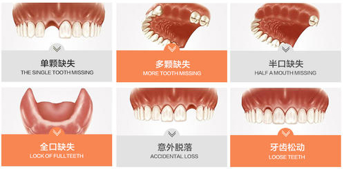 种植牙适应症状