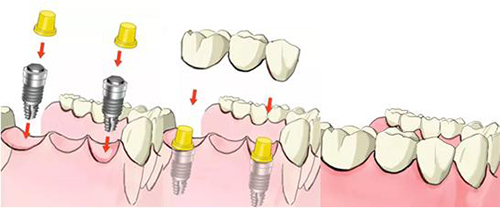 三颗种植牙过程演示