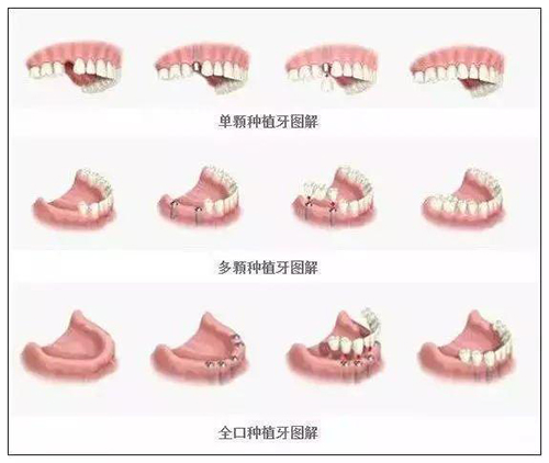 单颗、多颗、全口种植牙图解