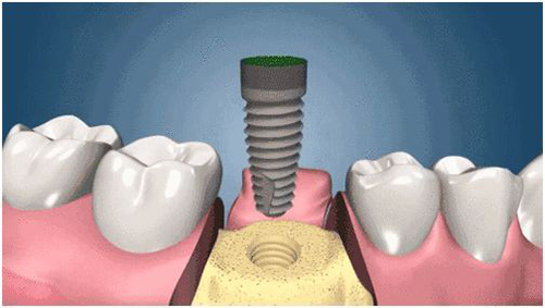 种植牙植体植入