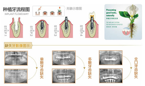 种植牙需要几次完成？牙齿一次性可以同时种多少颗？