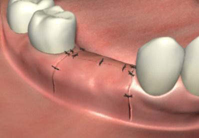 種植牙骨結(jié)合縫合