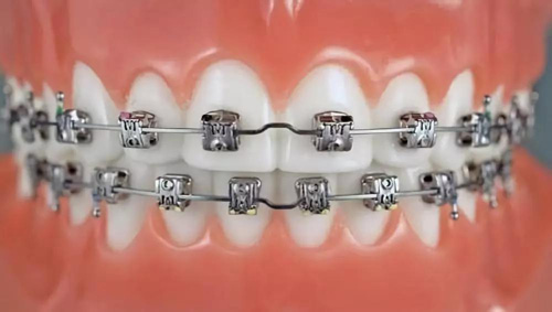 传统金属托槽牙齿矫正