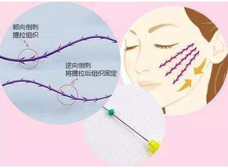 埋线提升面部可以维持多久?有能保持永久的线吗?看文章了解