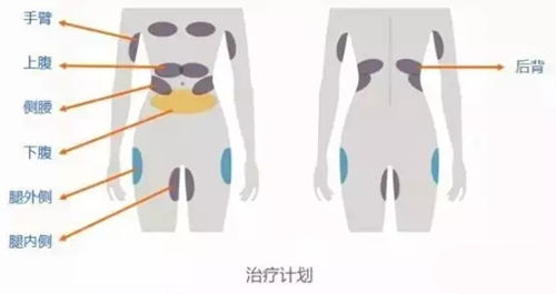 可以进行酷塑冷冻减脂的部位