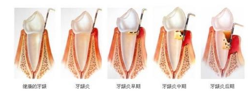 有牙周炎可以怀孕吗?会不会对胎儿有影响?这些可能造成影响