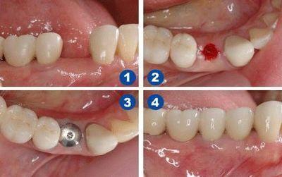 瑞典诺贝尔种植牙手术流程