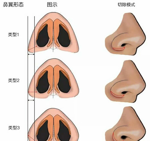 鼻翼缩小的3种类型鼻