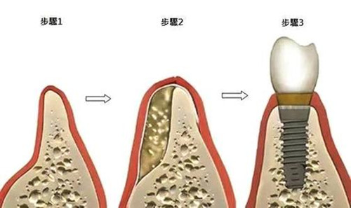 骨粉种植到种植牙的过程