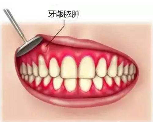 牙周炎的表现形式