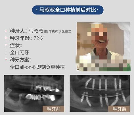 南宁种植牙哪家医院好?南宁柏乐口腔种植牙咋样?价格日记