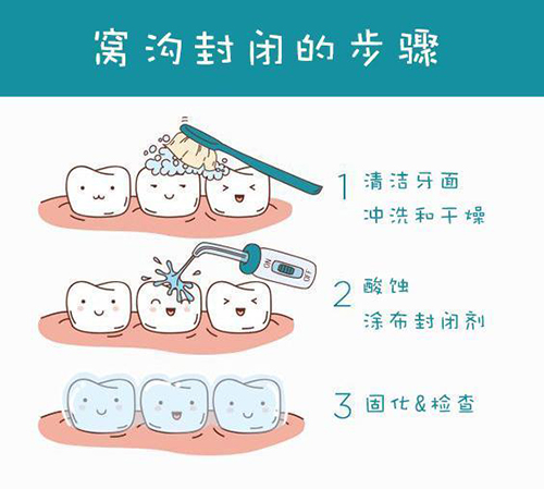 窝沟封闭的步骤