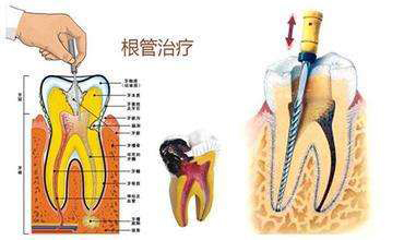 根管治療圖解