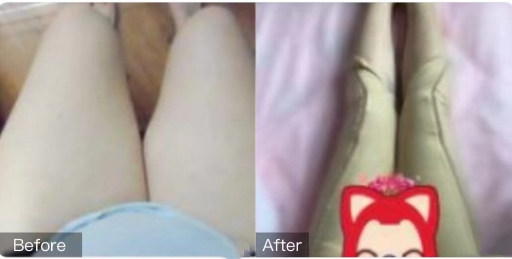 合肥维多利亚阿整形外科大腿吸脂图片